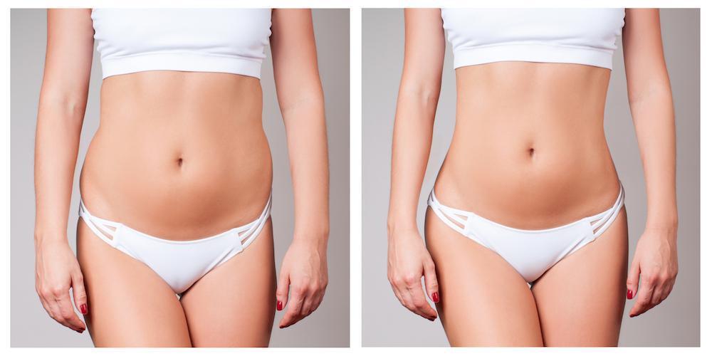 Las Vegas Laser Lipo