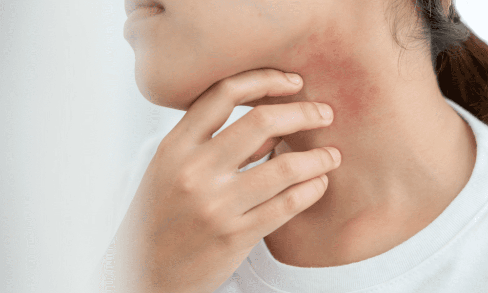 Spring Pollen Rash Rashes & Skin Irritation in Spring: Allergies, Heat & Sweat Triggers ...