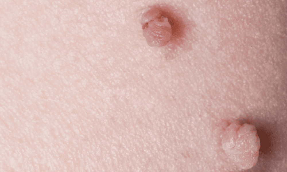 Skin Tags & Growths: Safe In-Office Removal | Dermatologists located in ...