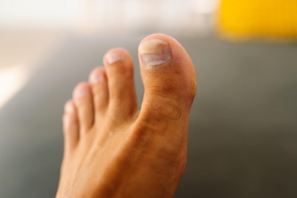Discolored Feet and Legs: What Does it Mean? | Vascular Vein Centers ...