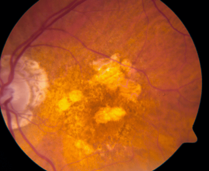 Retinal photograph of AMD
