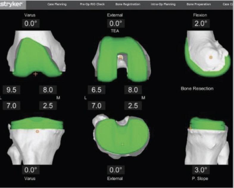 Muscle Sparing Robotic Assisted Knee Replacement