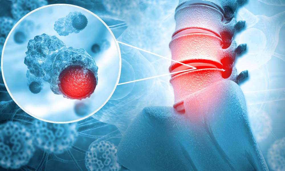 Max Stumer Max Steuer, MD | Neurosurgeons & Spine Specialists located in Atlanta, GA