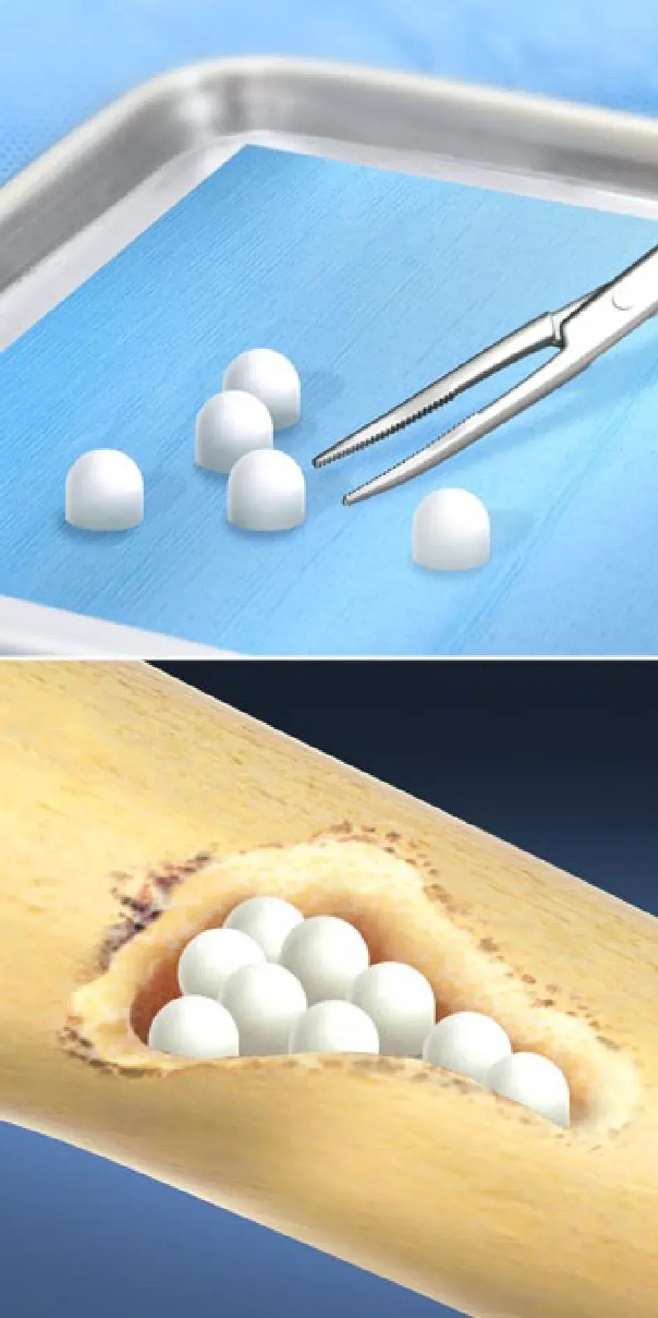 Absorbable Antibiotic Bead Treatment For Osteomyelitis Orthopedic 