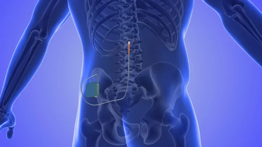 5 Reasons to Consider Spinal Cord Stimulation