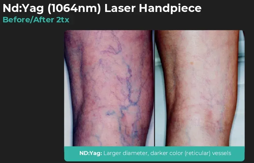 Cosmetic Vascular Laser Treatment of Reticular and Spider Leg Veins: Before and after 2 treatment sessions
