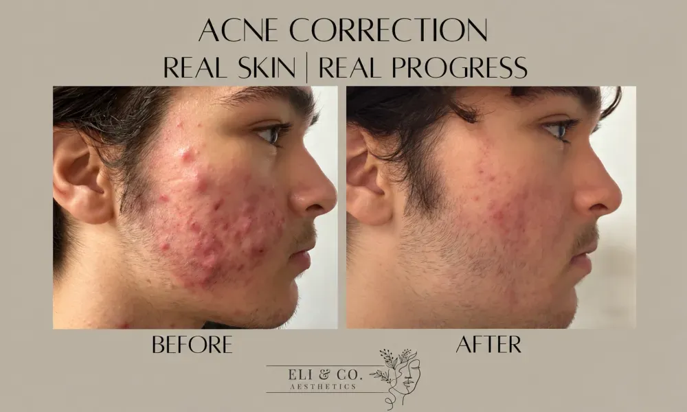 Acne Transformation
