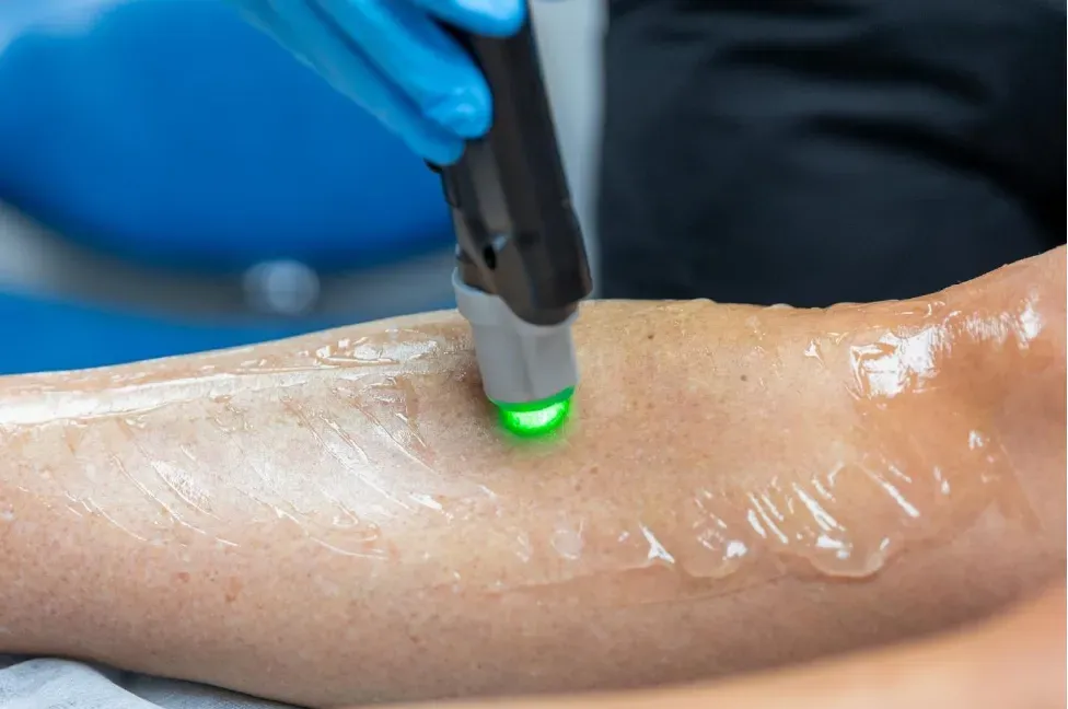 Permanent Laser Removal of Unwanted Hair