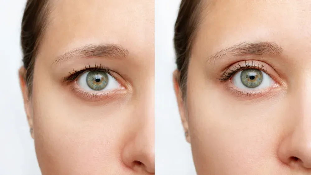 Eyelid Surgery — A Minor Procedure That Delivers Major Results