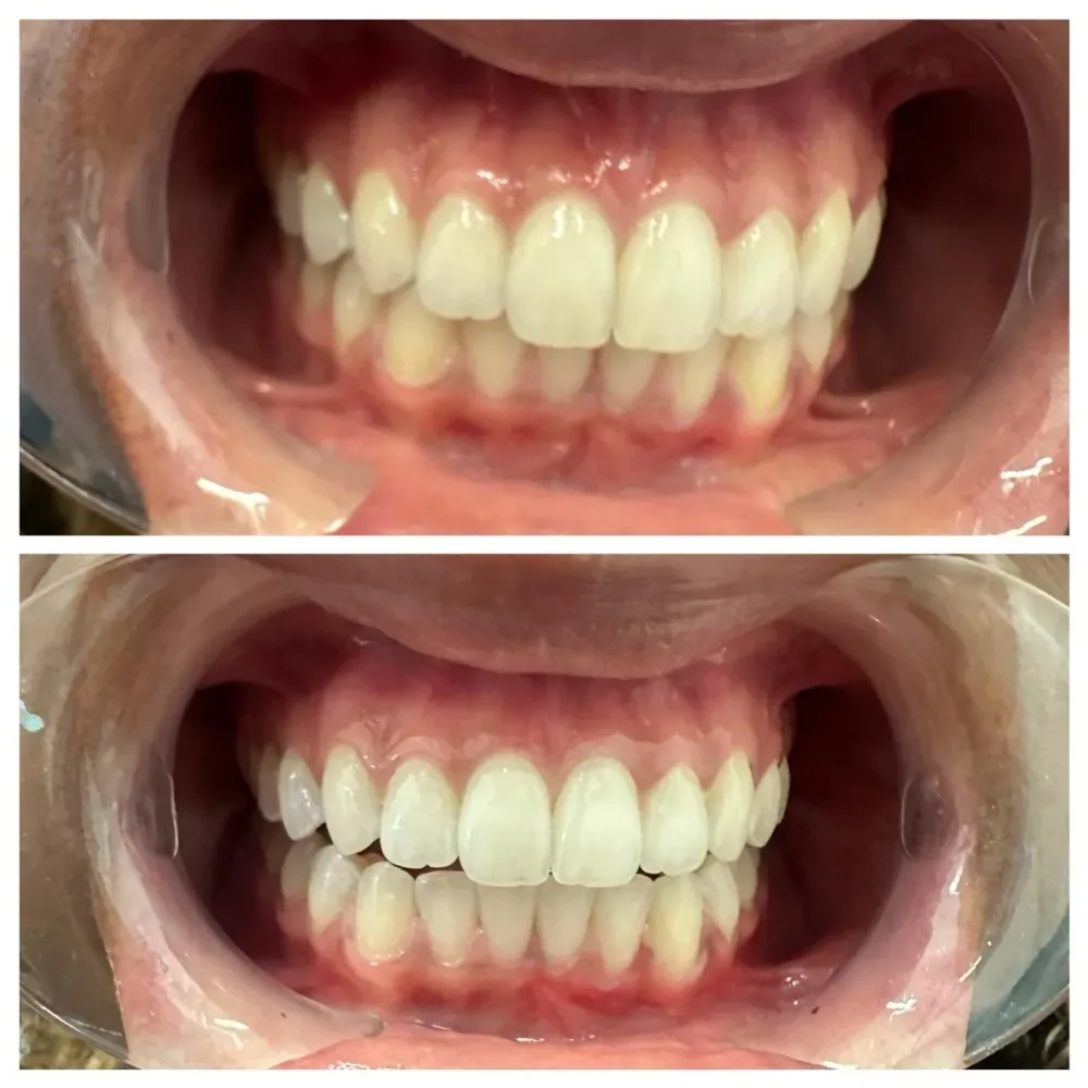 Before and after teeth whitening treatment showing the transformation from stained, yellowish teeth to a brighter, whiter smi