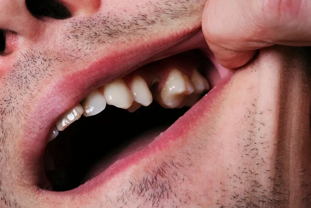 Lost a Tooth? Here's How Dental Implants Can Restore Your Confidence