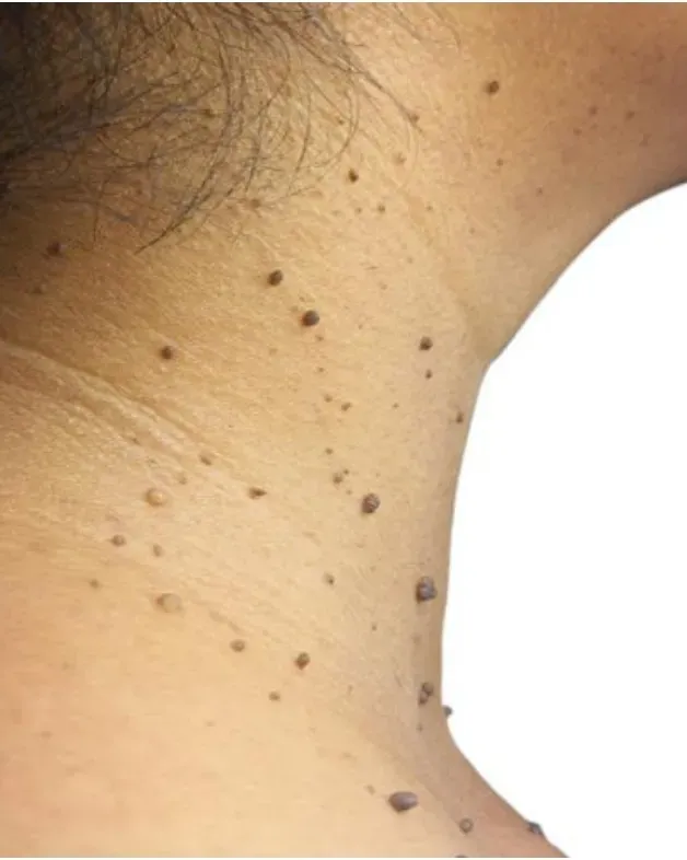 Skin Tags and Moles