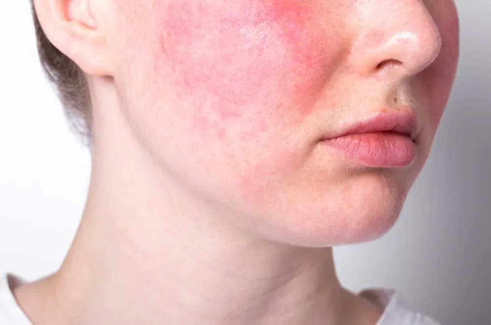 How to Manage Rosacea Flares With Professional Skin Care