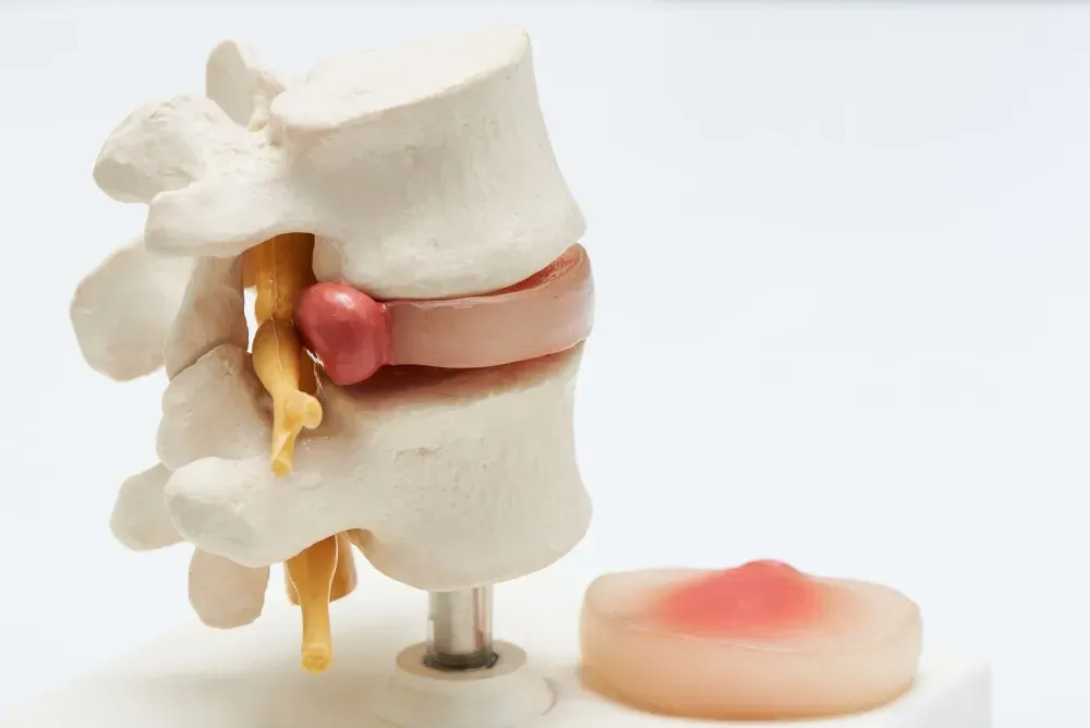 Is It a Herniated Disc or Degenerative Disc Disease? Key Signs
