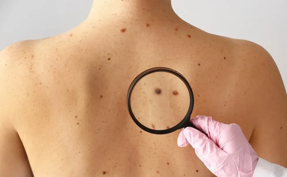 Is That New Mole Harmful? How Dermatologists Spot the Early Signs of Melanoma