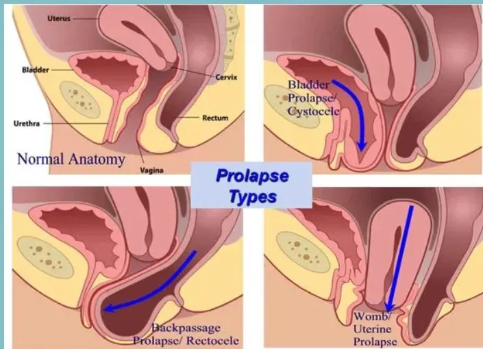 Pelvic Organs Prolapse - Pelvic Floor Dysfunction