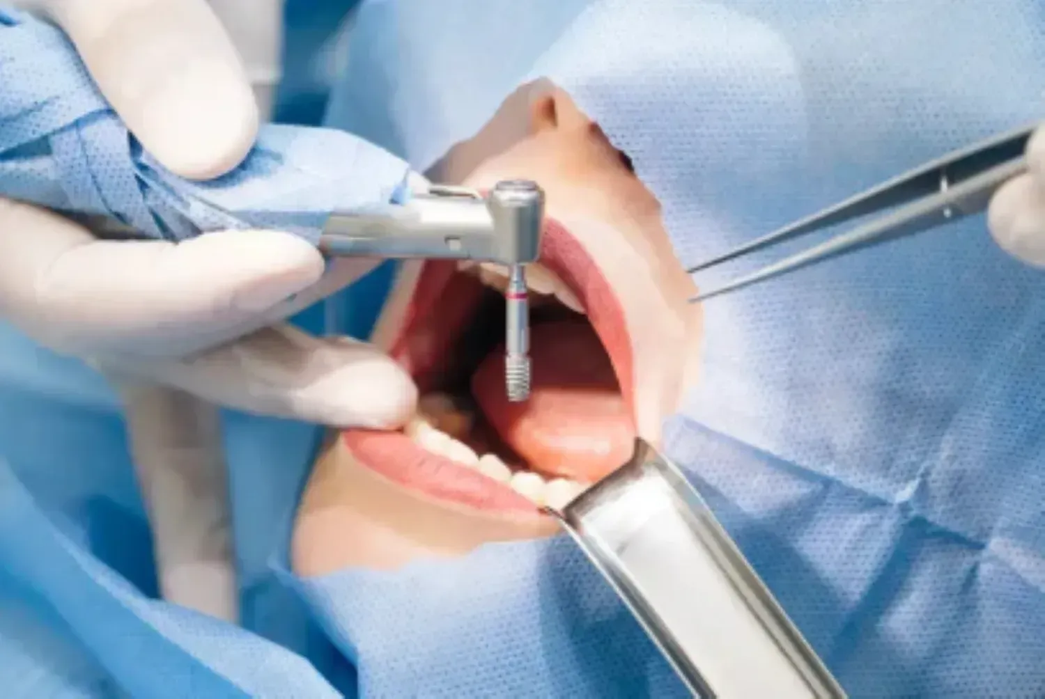 Oral Surgery in East Orange, NJ