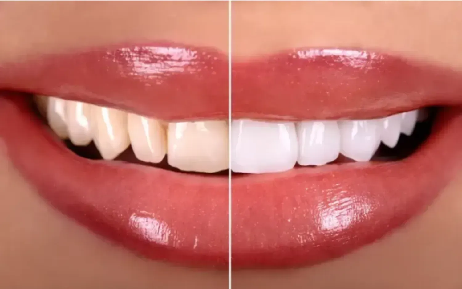Teeth Whitening &amp; Veneers in East Orange, NJ