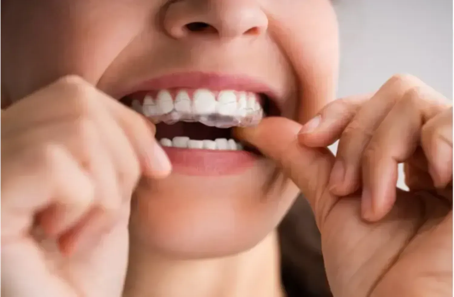 Invisalign in East Orange, NJ