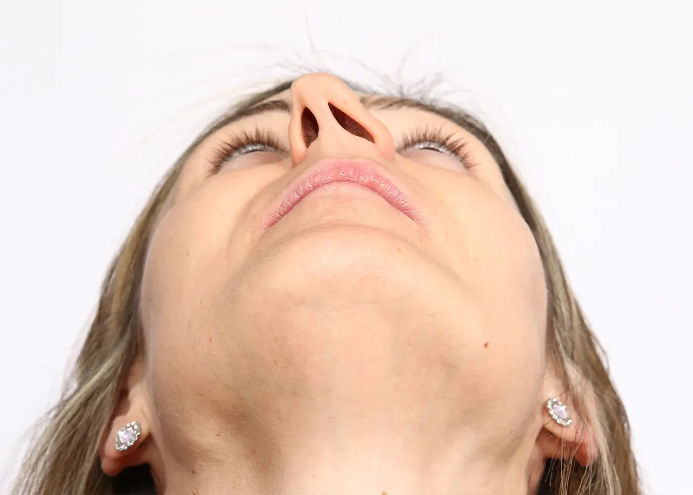 Deviated Septum