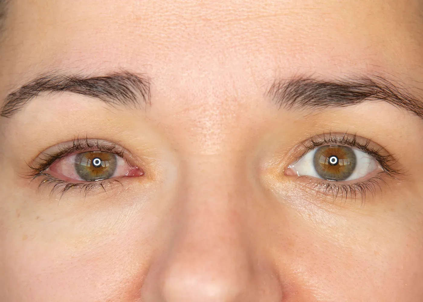 Pink Eye