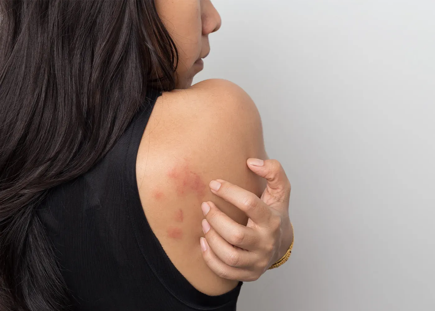 Rashes