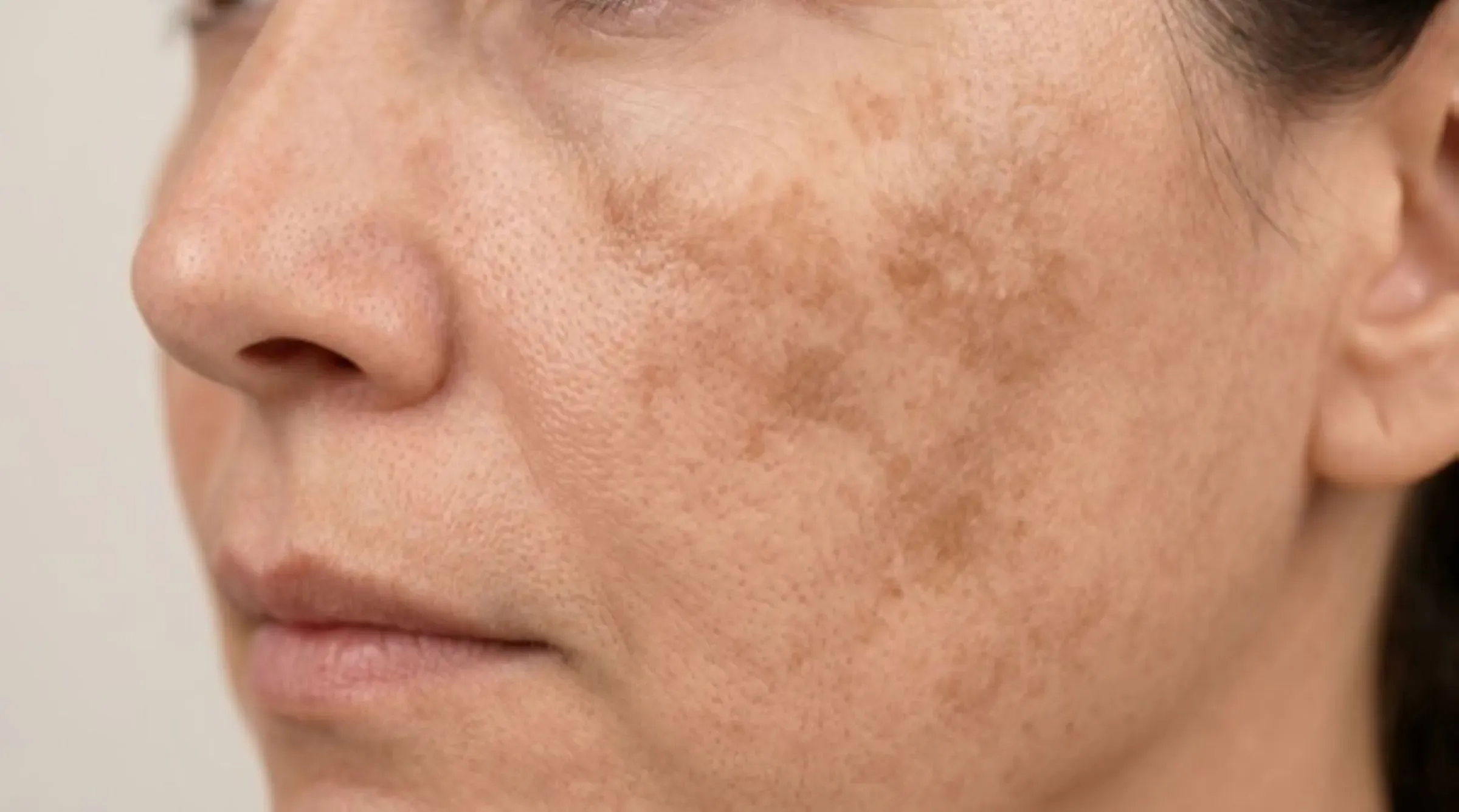 Melasma