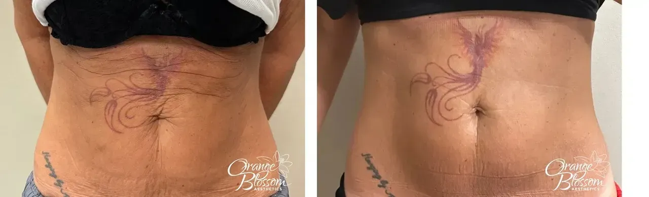 Body Contouring