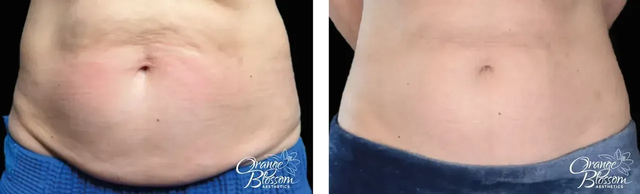 Body Contouring