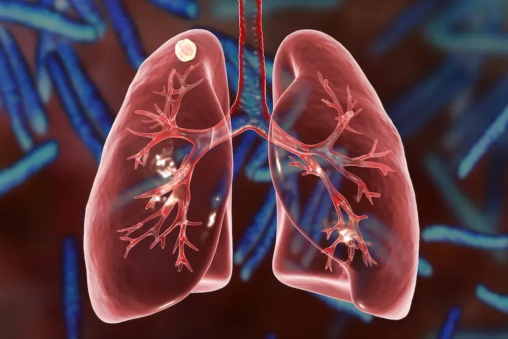 Mesothelioma