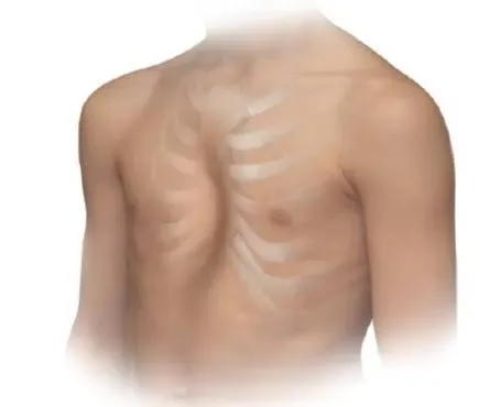 Chest Wall Deformities