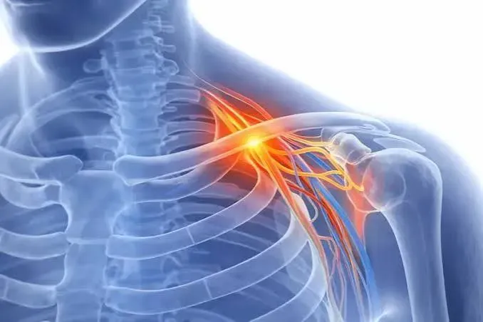 Thoracic Outlet Syndrome