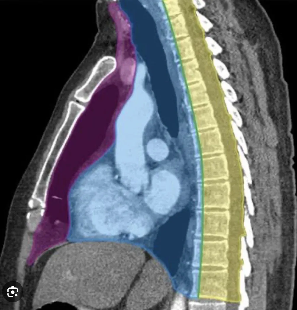 Mediastinal Mass