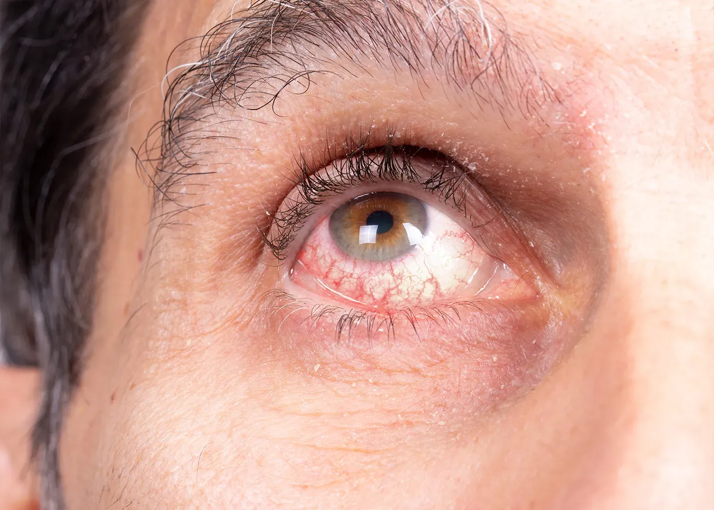Uveitis