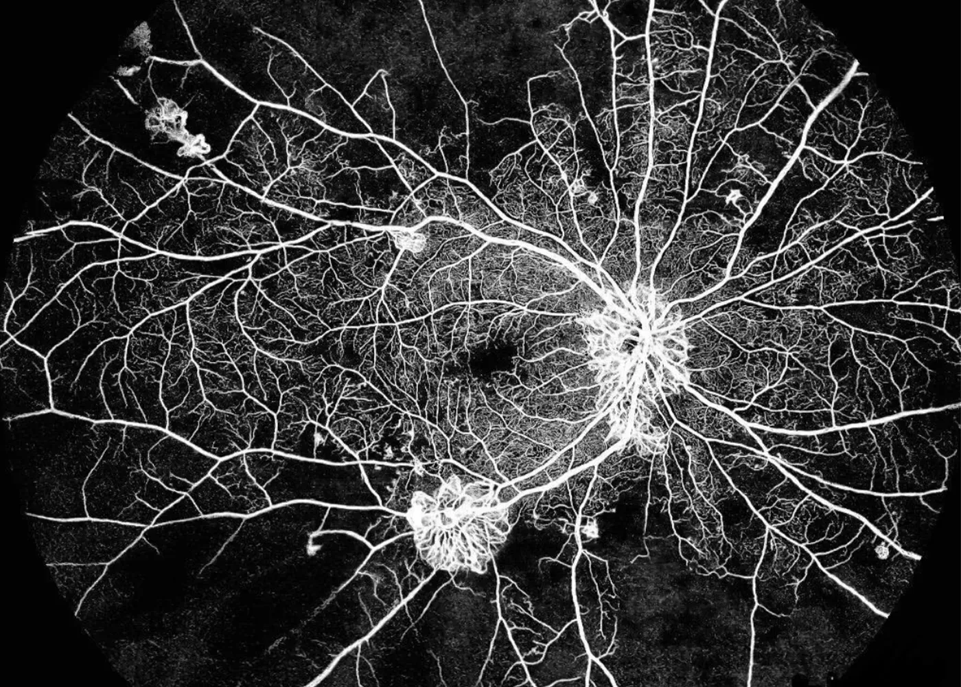 Diabetic Retinopathy