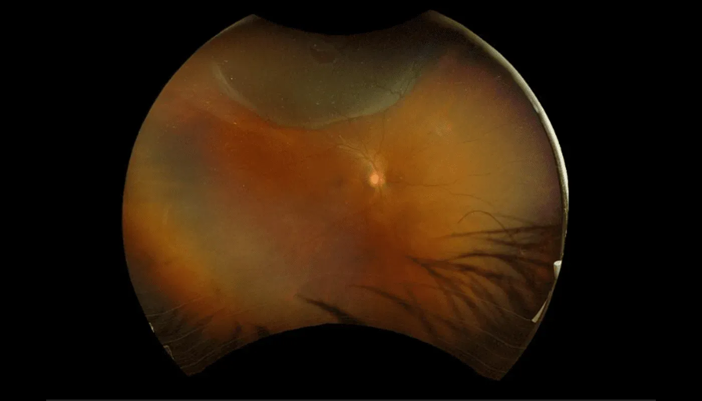 Retinal Tears and Detachment