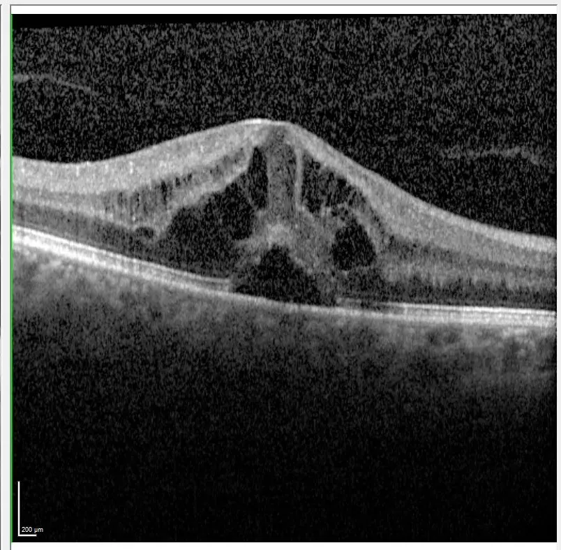 Macular Edema