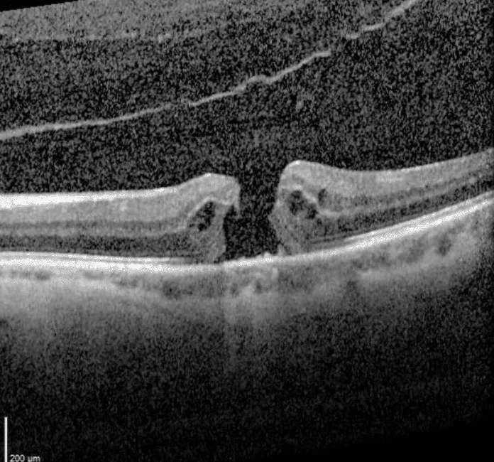 Macular Hole