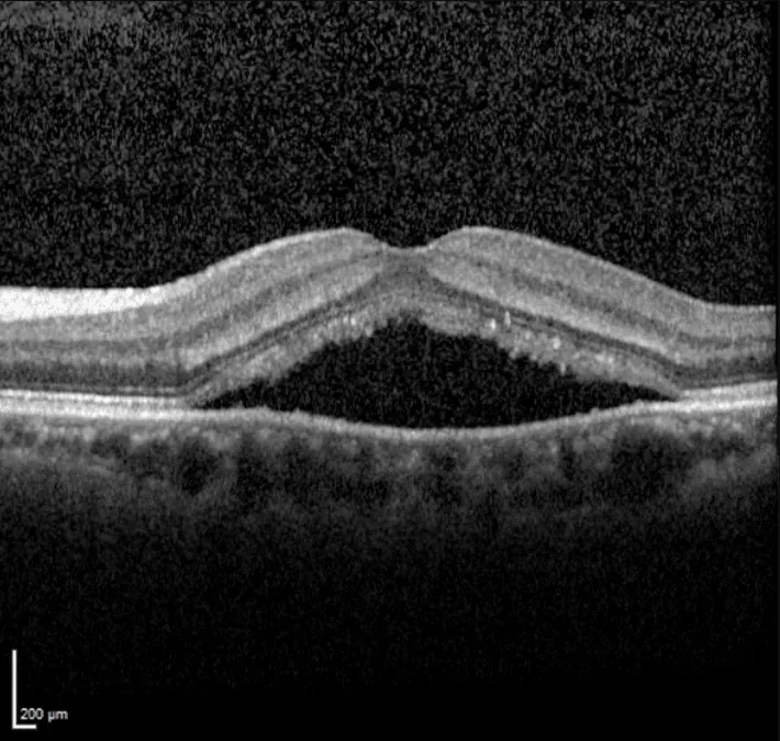 Central Serous Retinopathy