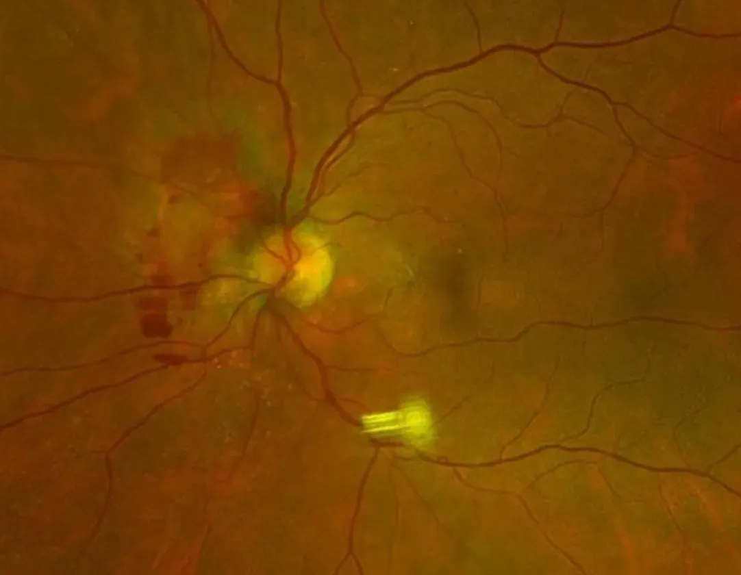 Macular Degeneration