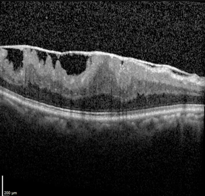 Epiretinal Membrane