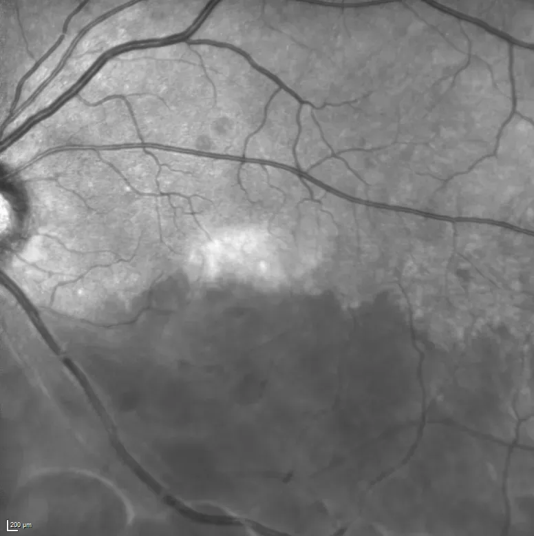 Retinal Artery Occlusion
