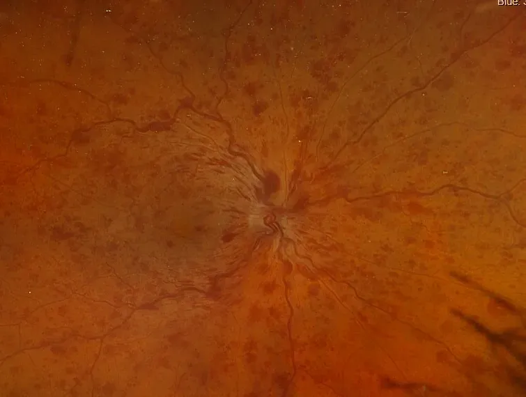 Retinal Vein Occlusion
