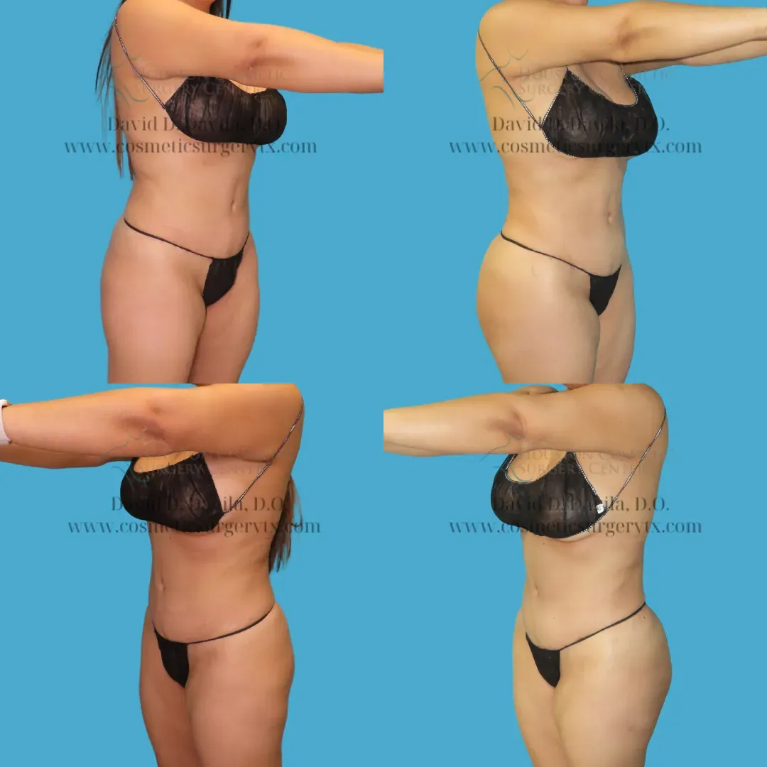 brazilian butt lift Before and After