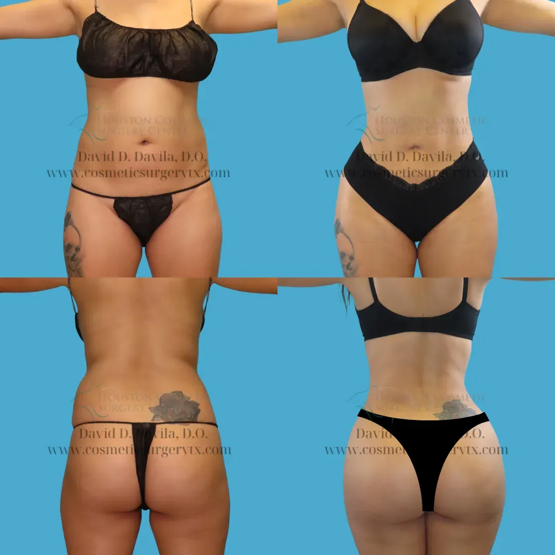 brazilian butt lift Before and After