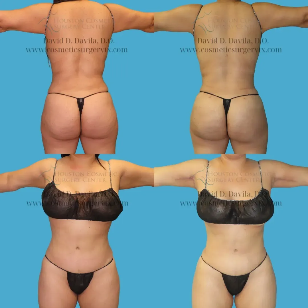 brazilian butt lift Before and After
