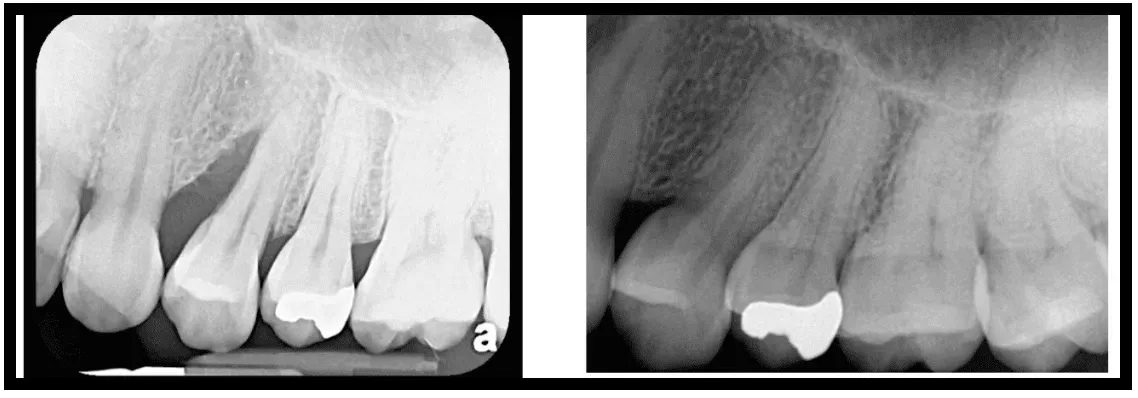 LANAP For Teeth | Board Certified Periodontists & Dental Implant ...