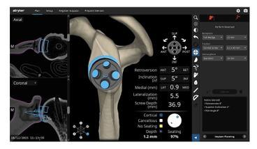 Preoperative 3D personalized planning  for a Robotic Reverse Shoulder Replacement.