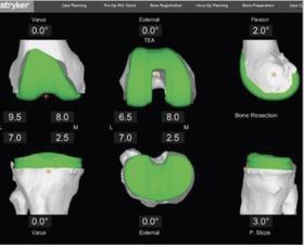 Muscle Sparing Robotic Assisted Knee Replacement
